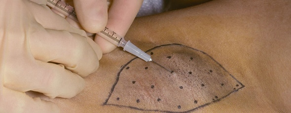 Лечение гипергидроза