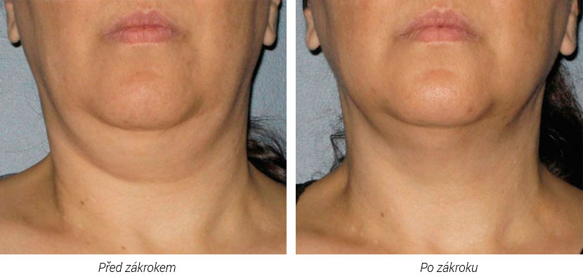 Ulthera/Альтера