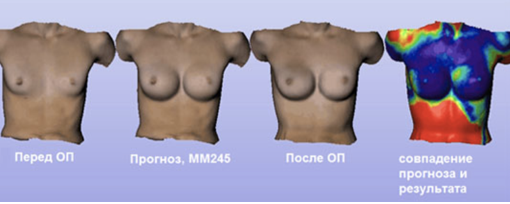 Пластика груди – позволь себе быть привлекательной!