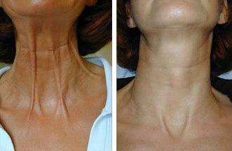 Процедура фотоомоложения Процедура фотоомоложения