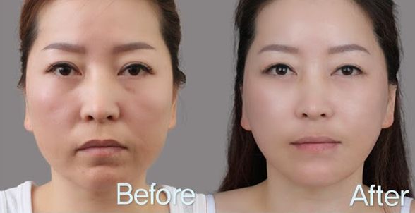 тредлифтинг мезонитями отзывы