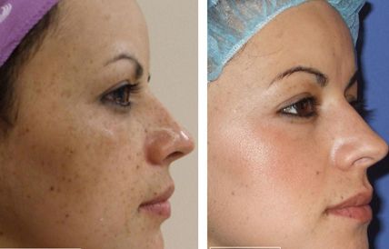 пилинг трихлоруксусной кислотой пилинг трихлоруксусной кислотой