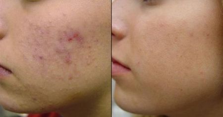 отзывы ТСА пилинг отзывы ТСА пилинг