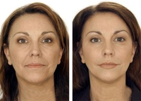 филлеры в носогубки филлеры в носогубки