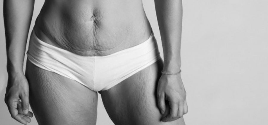 Пластика после родов (грудь, живот, интимная зона)