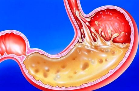 кислотность желудка повышена как лечить 