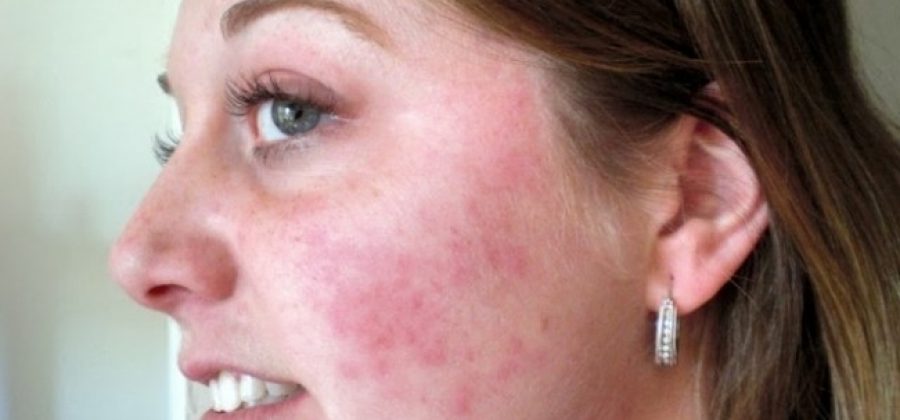 На лице появились красные пятна – как их убрать?