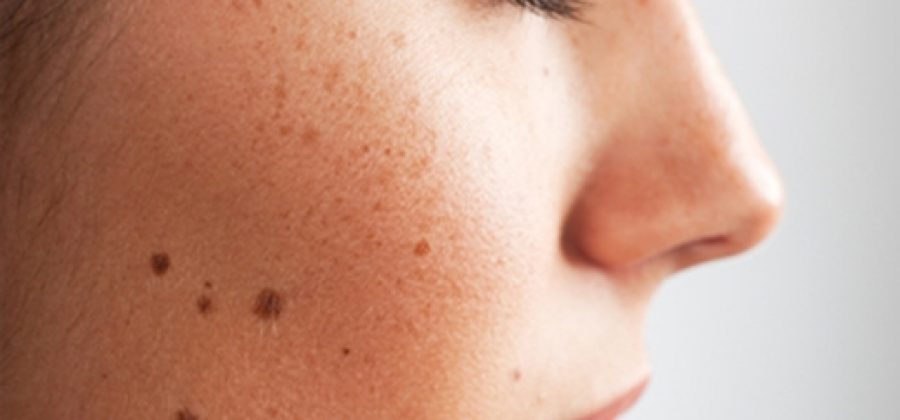 Как удаляют лазером родинки на лице, каковы последствия?
