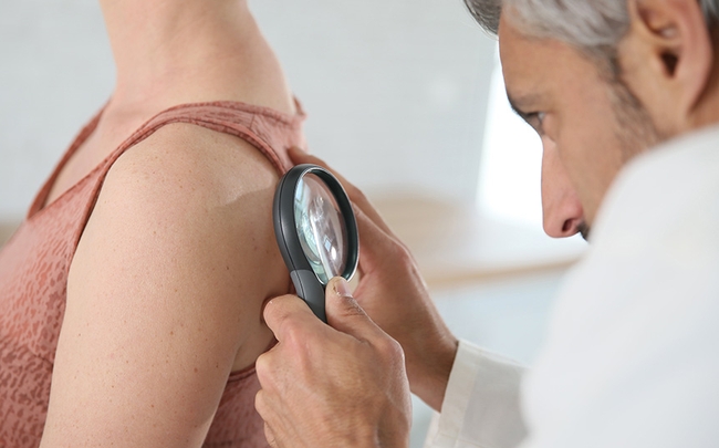 Что такое себорейный кератоз и как его вылечить?