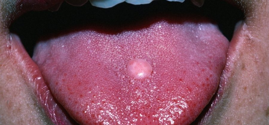 На языке появилась шишка – что делать?