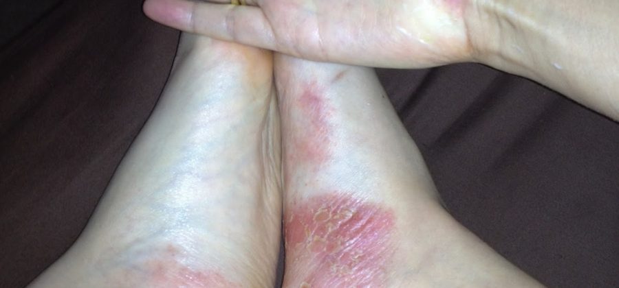 Как нужно питаться при псориазе: правильная диета