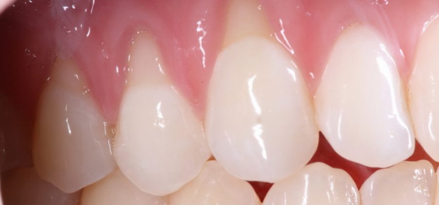 Почему опускаются десны и как это лечить?