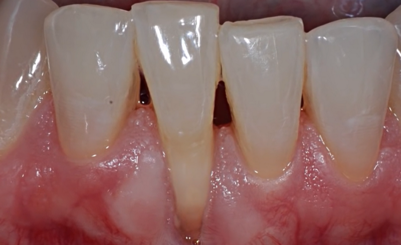 Опускание десны на нижних зубах лечение в домашних условиях