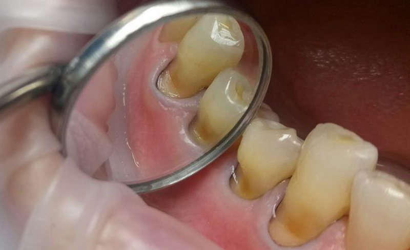 Опускание десны на нижних зубах лечение