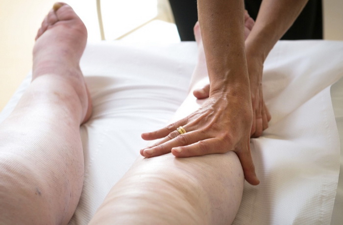 Как лечить отек ног у лежачих больных