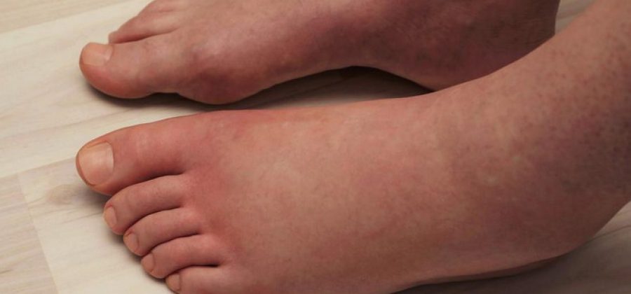 10 способов победить отеки ног у лежачих больных