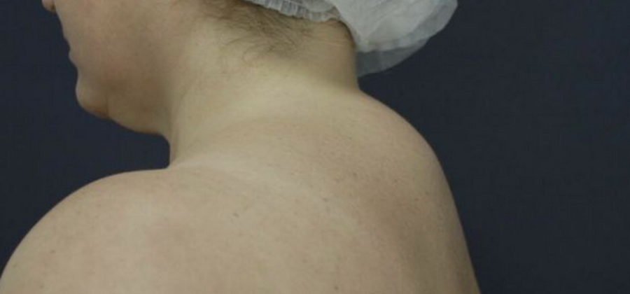 Как убрать вдовий горбик самостоятельно – лучшие упражнения и методы