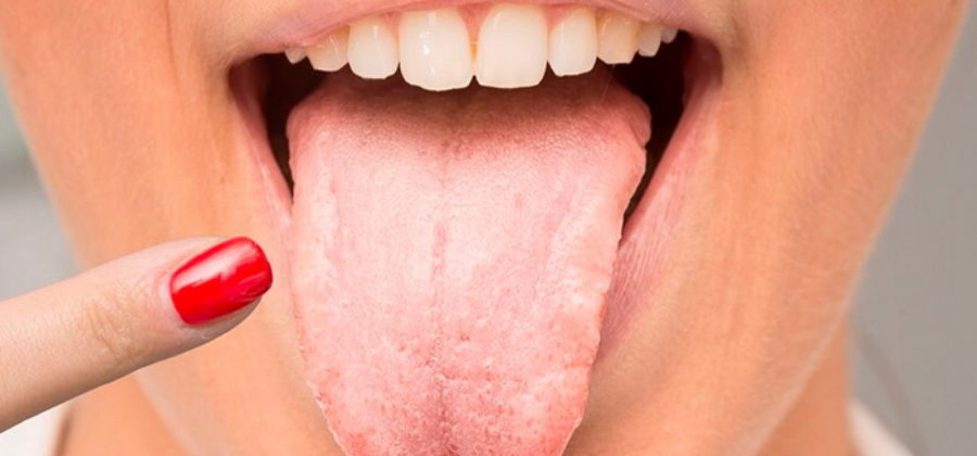 Почему на языке у взрослых появляется белый налёт?