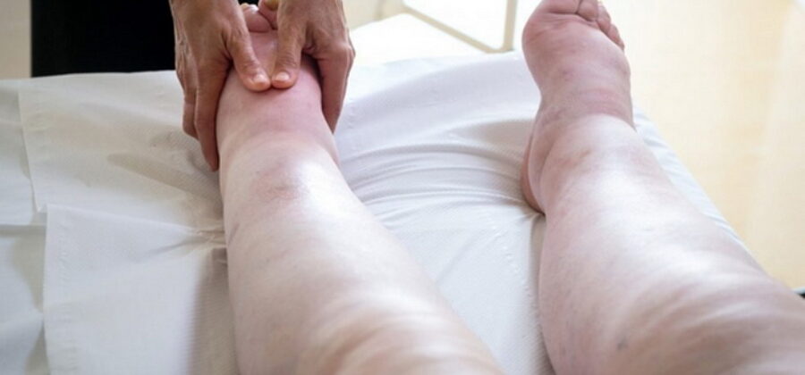 Как распознать застой лимфы в организме — главные симптомы