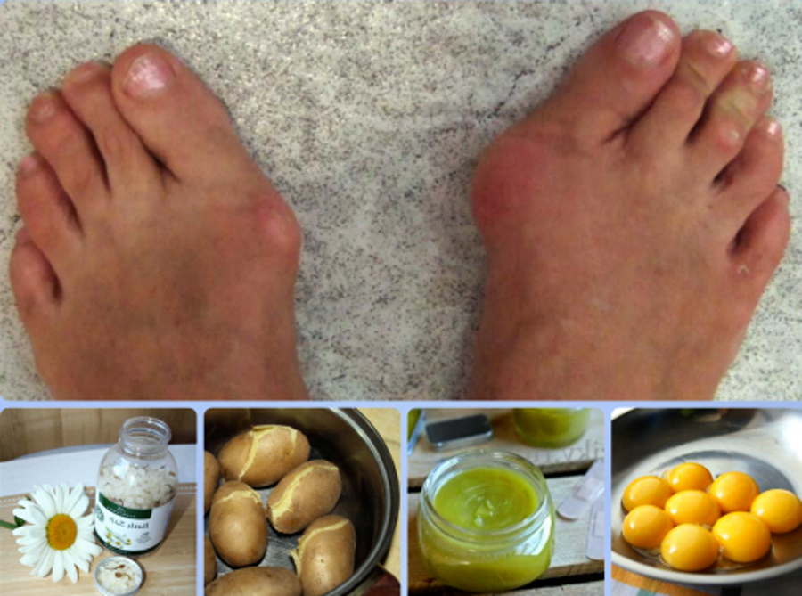 11 способов избавиться от косточки на большом пальце ноги