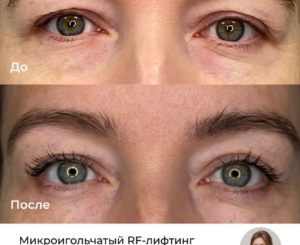Что такое микроигольчатый RF-лифтинг?