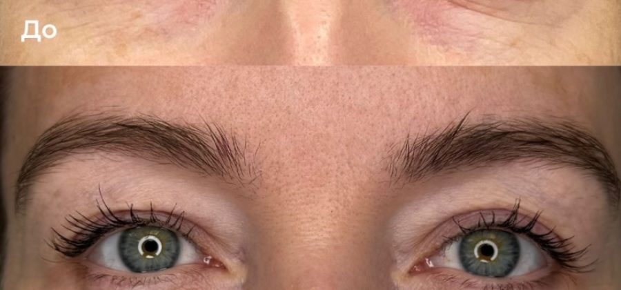 Что такое микроигольчатый RF-лифтинг?