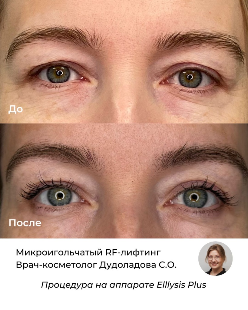 Что такое микроигольчатый RF-лифтинг?