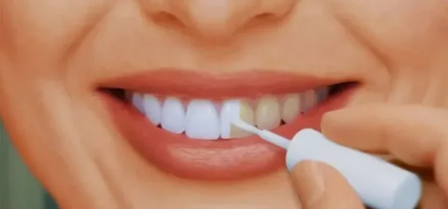 Отбеливание зубов: что это, виды процедур и как выбрать подходящую