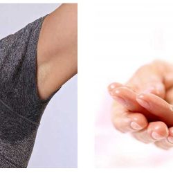 Когда нужно использовать ботокс от гипергидроза: подробное руководство