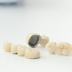 Металлокерамические коронки: что это, преимущества и способы установки