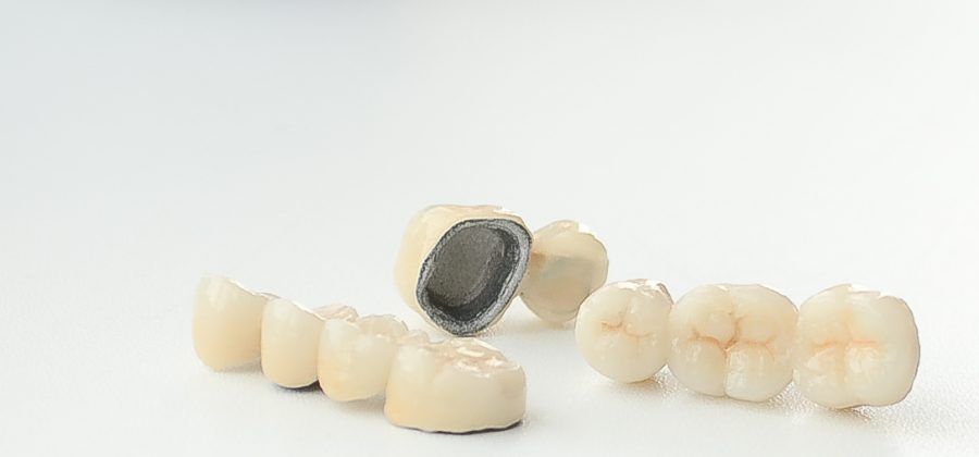 Металлокерамические коронки: что это, преимущества и способы установки