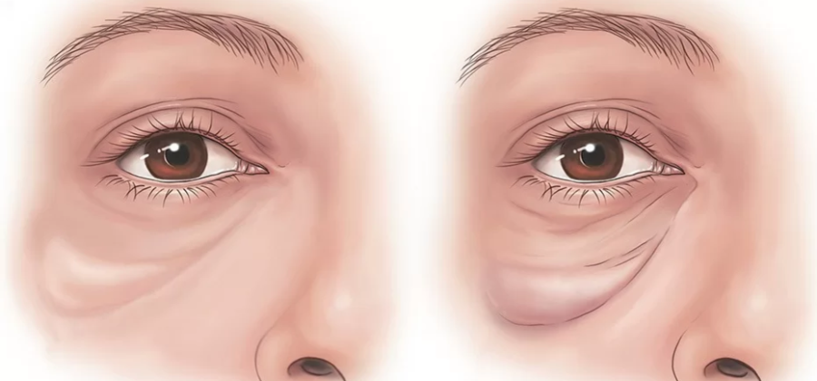 Техника воздействия на малярные мешки