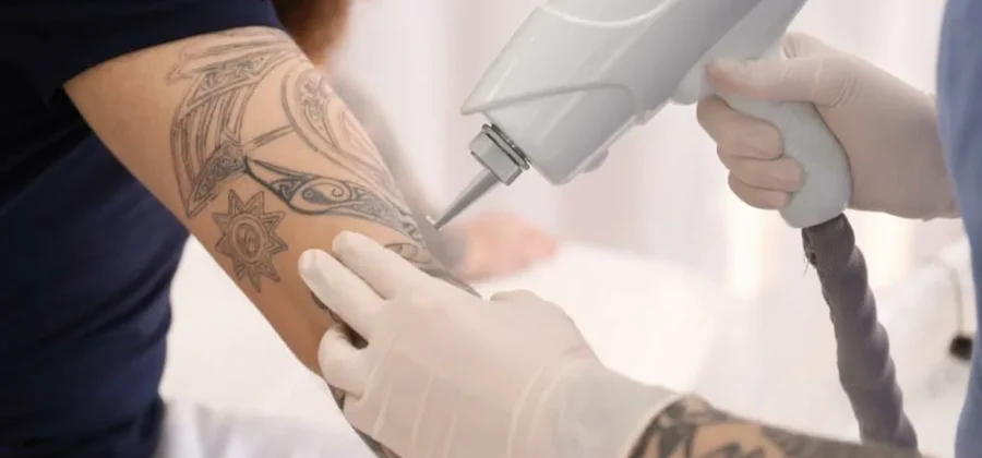 Удаление татуировок лазером: новое начало без следа