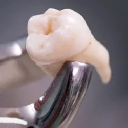 Удаление зуба по полису ОМС в стоматологической поликлинике «НАВА» в Москве