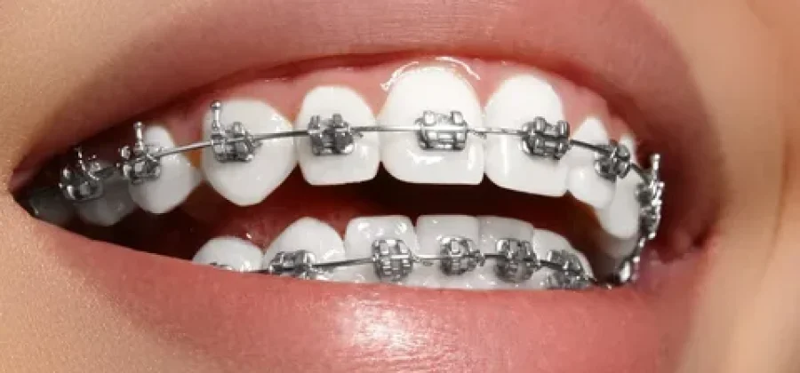 Улыбка без компромиссов: установка брекетов под ключ