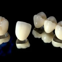 Металлокерамические коронки: золотая середина в протезировании зубов