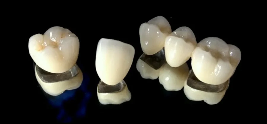 Металлокерамические коронки: золотая середина в протезировании зубов