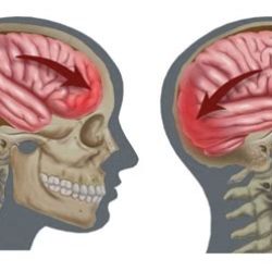 Сотрясение мозга у ребенка: что нужно знать родителям