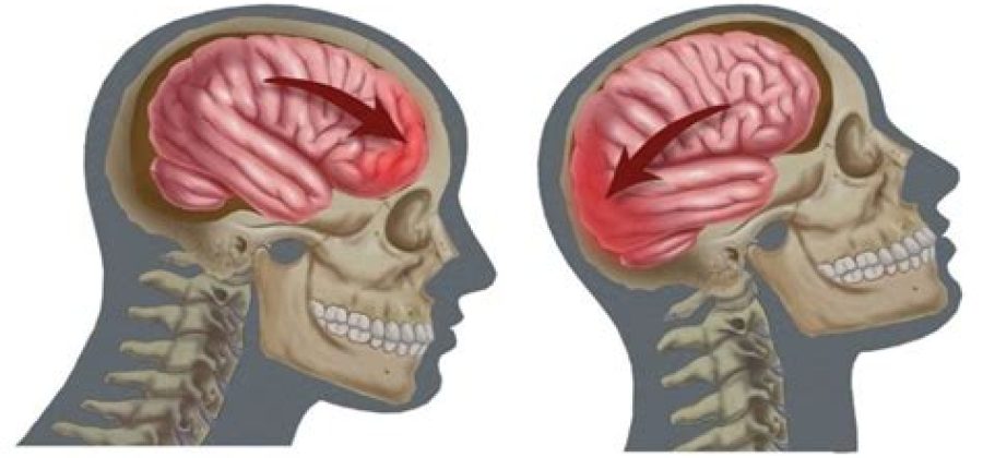 Сотрясение мозга у ребенка: что нужно знать родителям