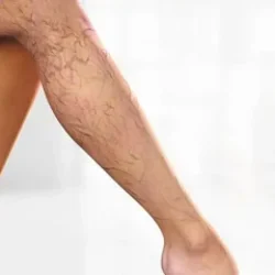 Варикозное расширение вен: причины и механизмы возникновения