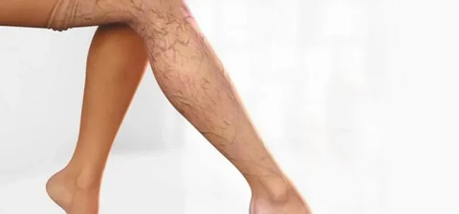 Варикозное расширение вен: причины и механизмы возникновения