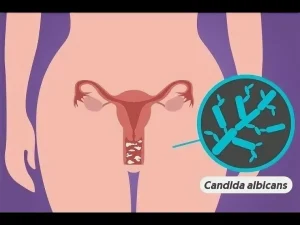 i (14) Лечение рецидивирующего кандидозного вульвовагинита: Что делать, если молочница не лечится