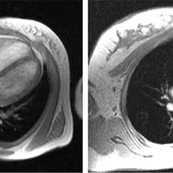 МРТ сердца с контрастированием для диагностики заболеваний и здоровья