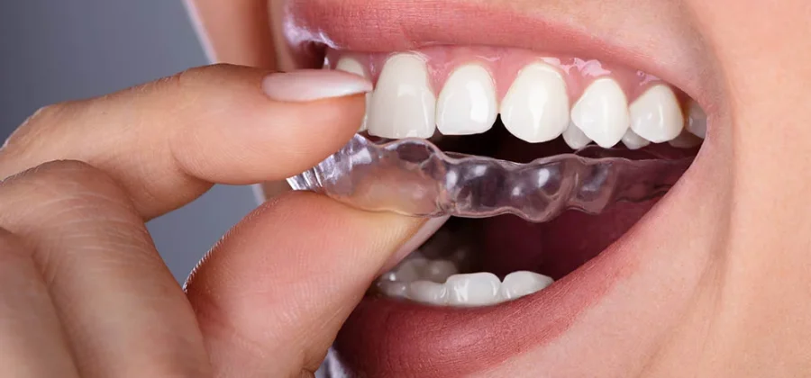 Элайнеры — современное решение для красивой улыбки: кому они подходят и почему их выбирают