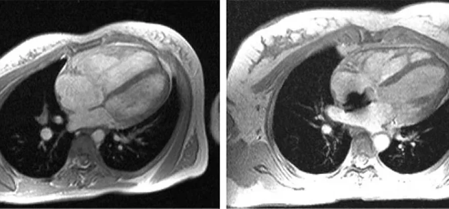 МРТ сердца с контрастированием для диагностики заболеваний и здоровья