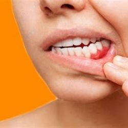 Опущение десны: почему важно вовремя заметить и вылечить проблему