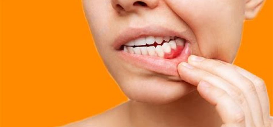 Опущение десны: почему важно вовремя заметить и вылечить проблему