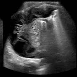 УЗИ плевральной полости — что это, когда и кому нужно, как проходит
