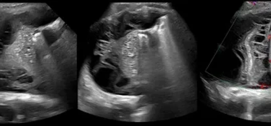 УЗИ плевральной полости — что это, когда и кому нужно, как проходит