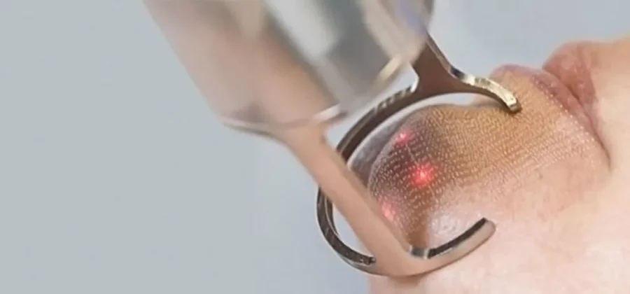 Лазерная шлифовка лица: что это такое и кому она подходит?